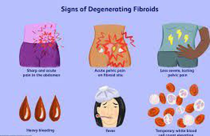 Symptoms of fibroids