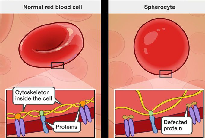 Hereditary spherocytosis