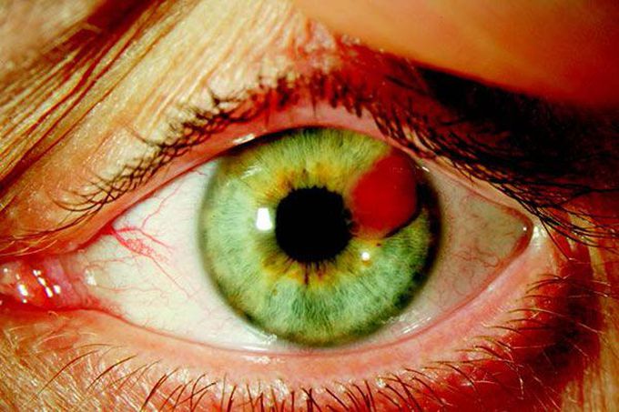 What is the cause of this solitary lesion of the iris in this 46-year-old man?