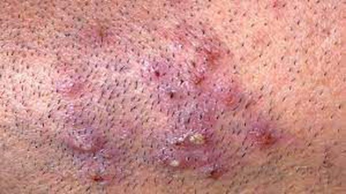 Ingrown hair