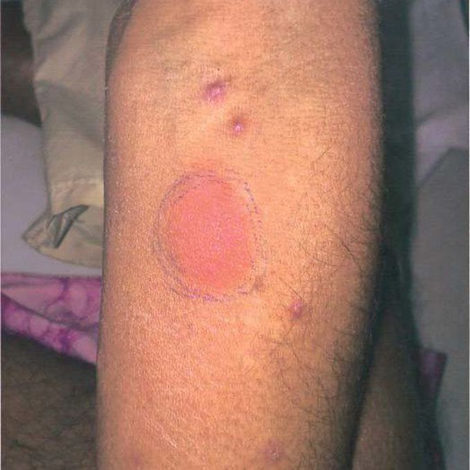 Mantoux Test MEDizzy