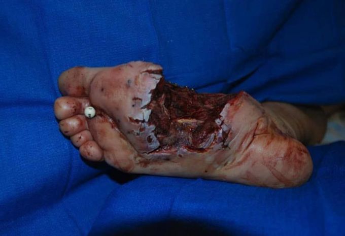 A case of an accidental gun shot wound to the foot while hunting! 