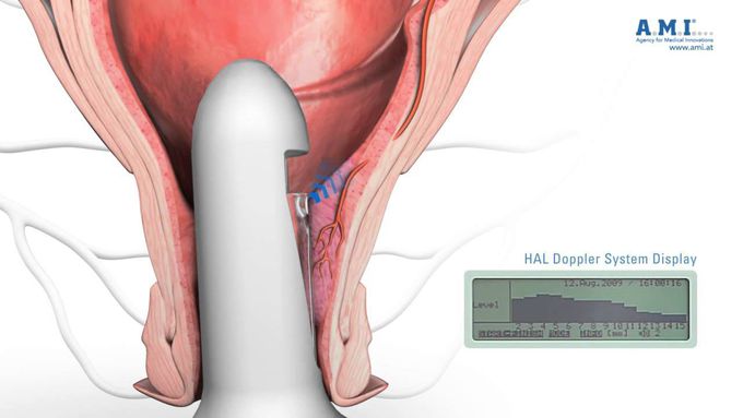 HAL Hemorrhoidal Artery Ligation