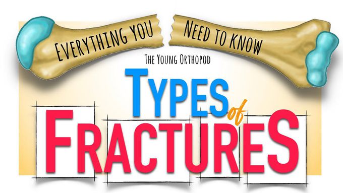 All about fractures