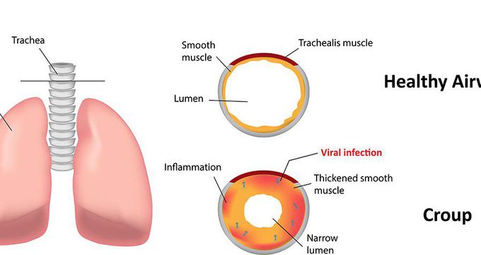 Symptoms of Croup