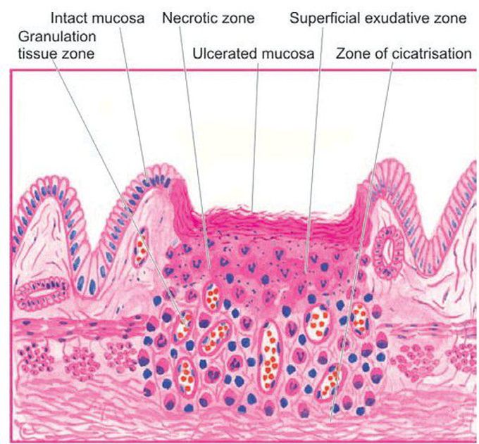 Chronic peptic ulcer.