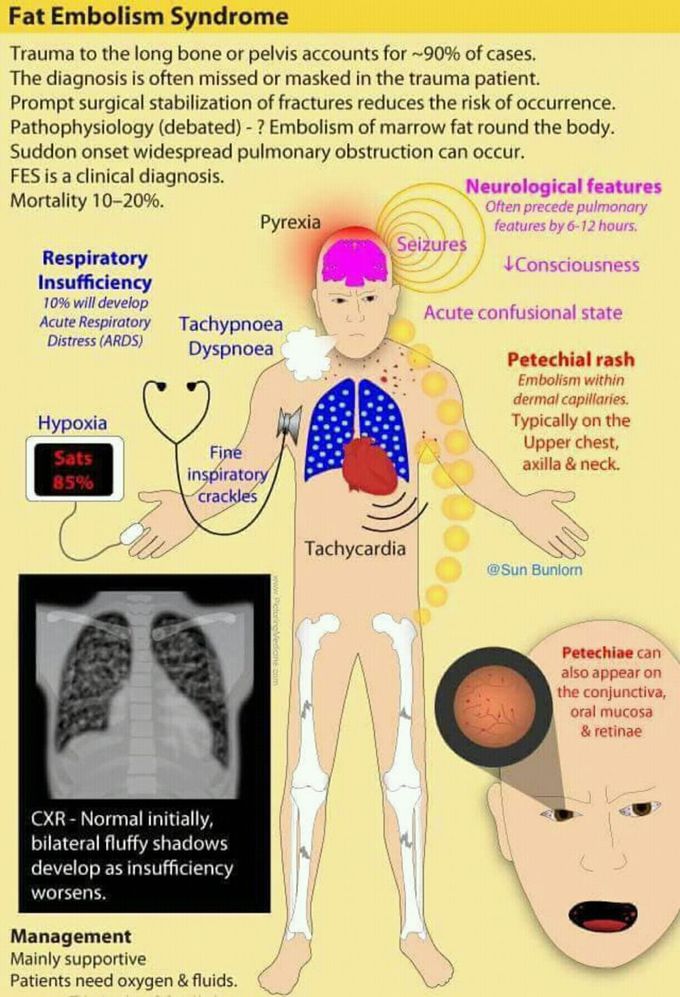 Fat Embolism Syndrome