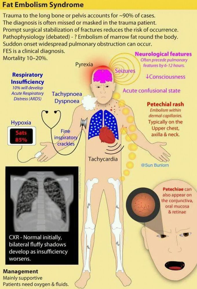 Fat Embolism Syndrome - MEDizzy