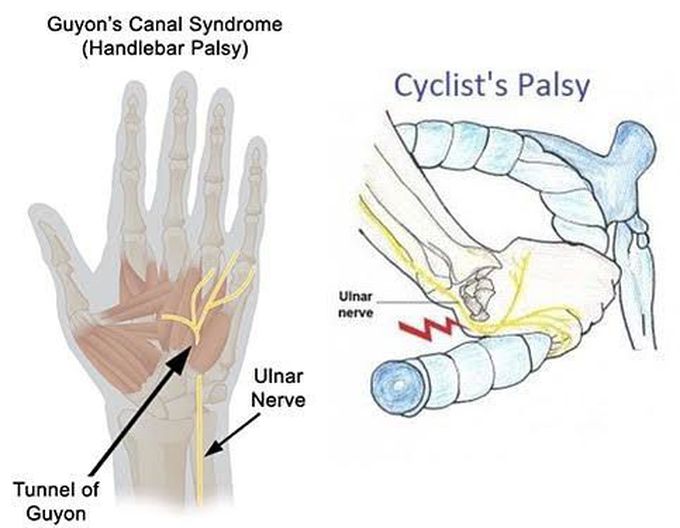Guyon's canal syndrome