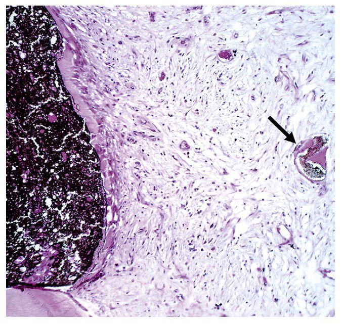 Human pulp capped with calcium hydroxide cement