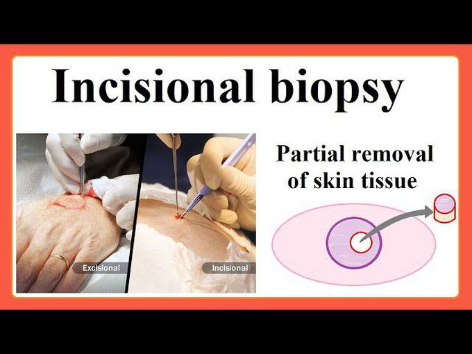 Incision biopsy