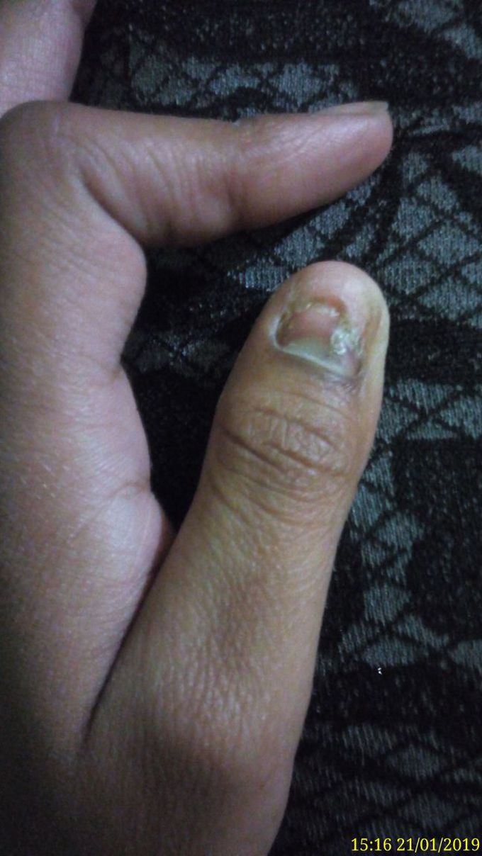 brown marks on thumb and embedded nail inside skin.