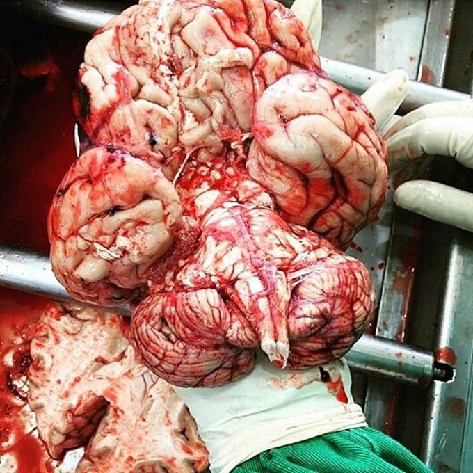 Dissected brain