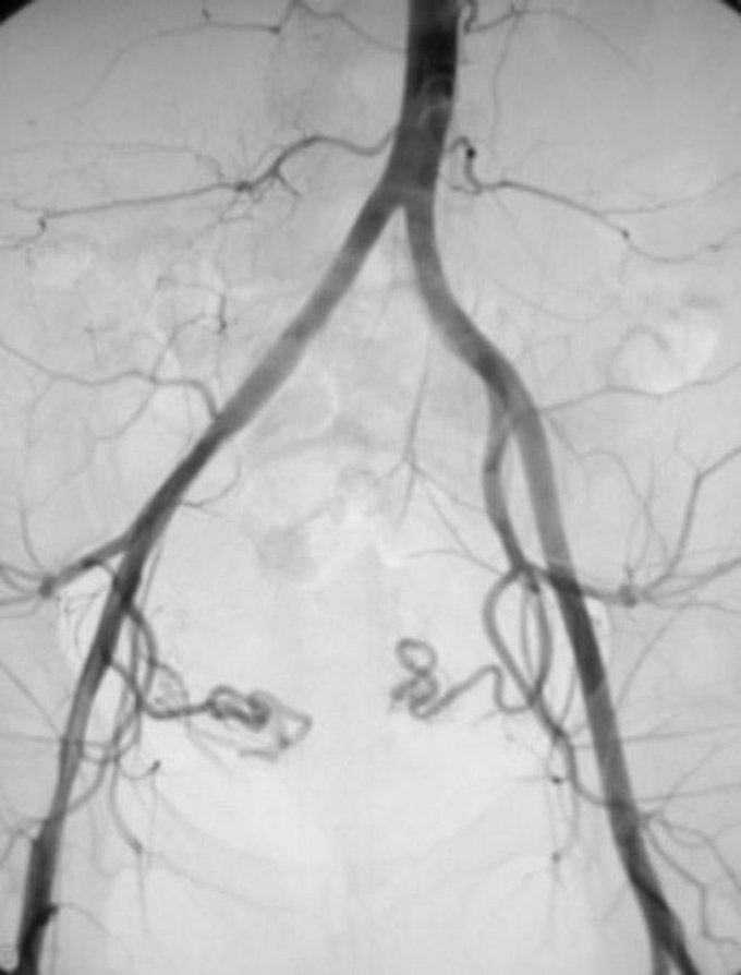 pre UFE (Uterine  fibroid embolization) angiogram