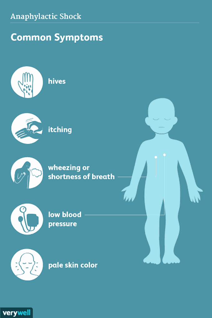 Symptoms of anaphylactic shock