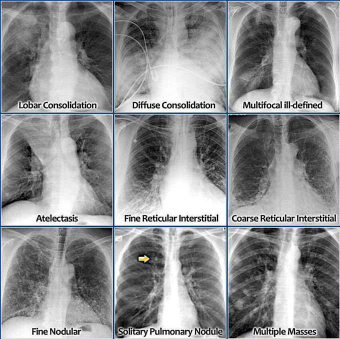 Chest X-ray interpretation