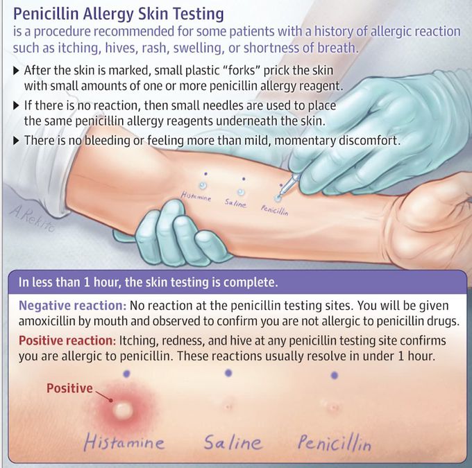 Penicillin Allergy Skin Test