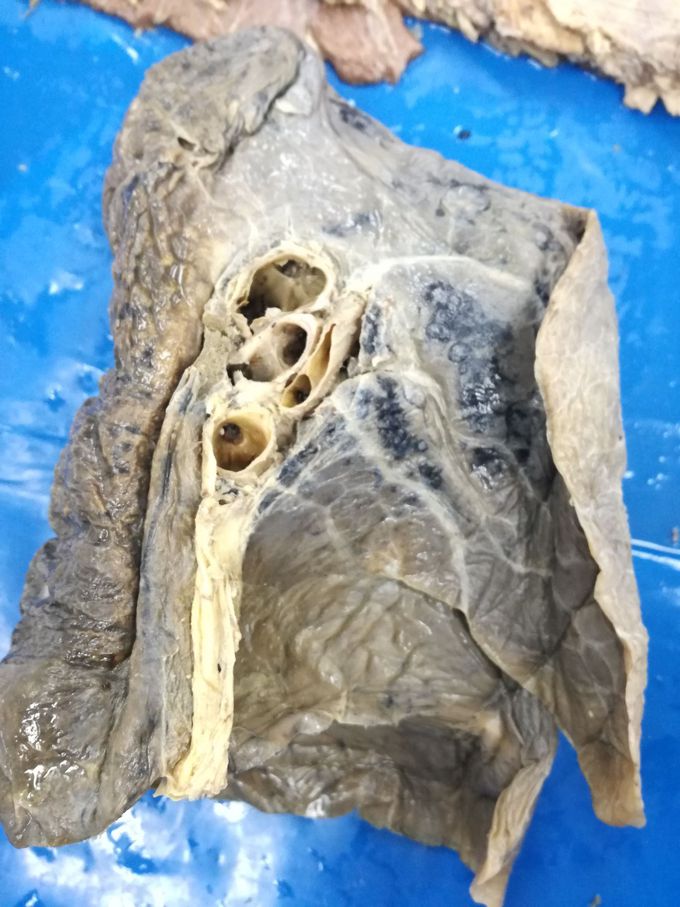 left or right lung?