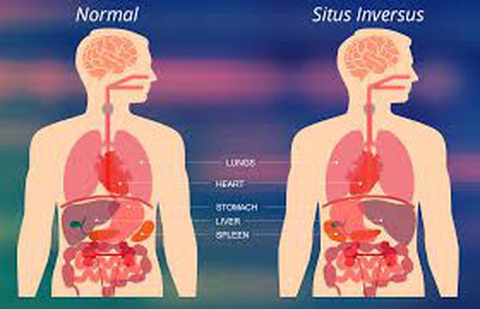 Situs inversus totalis