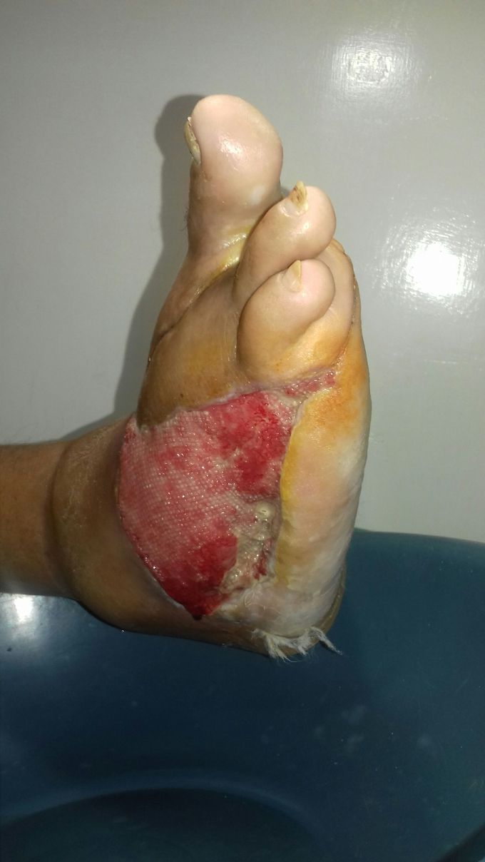 Pie Diabético