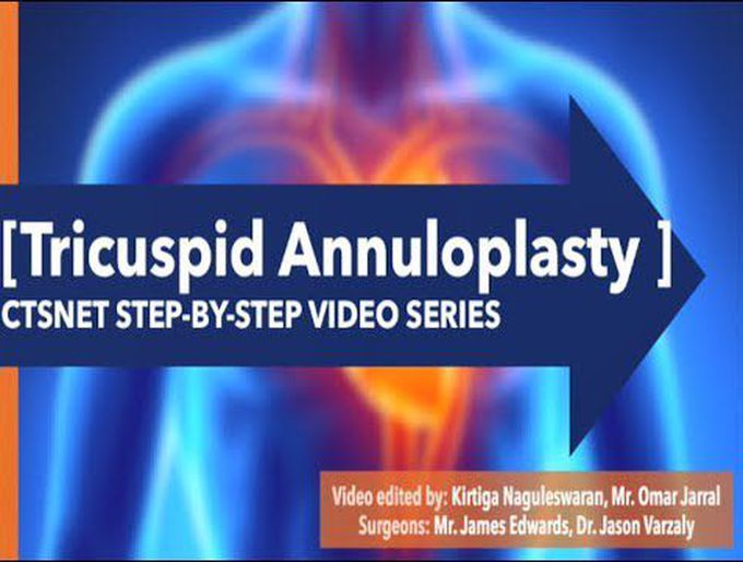 Tricuspid Annuloplasty