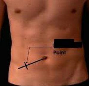 What is the name of this point for diagnosing appendicitis? - MEDizzy