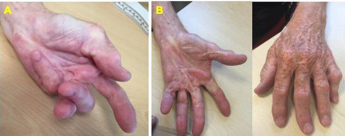 Dupuytren’s Contracture: The Permanently Flexed Fingers, and How to Manage Them
