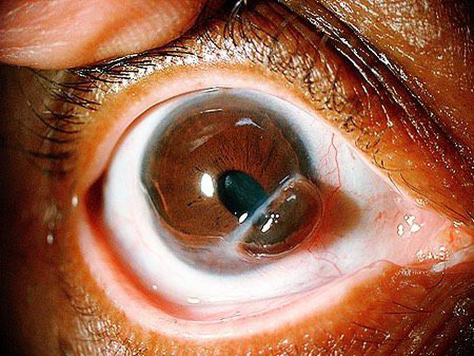 A corneal perforation with prolapsed iris!