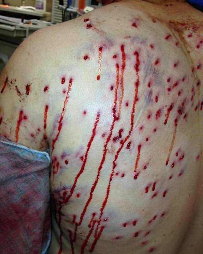 This is what being shot with a bird shot shotgun shell looks like after a burglary went bad for the bad guy.