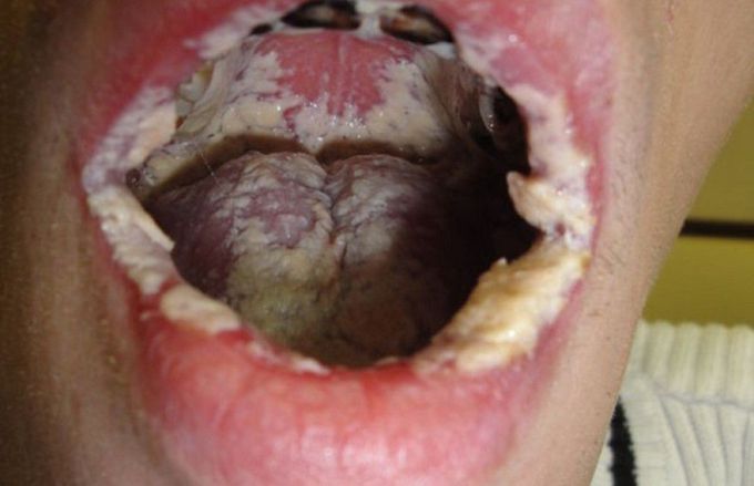Oral candidiasis😨