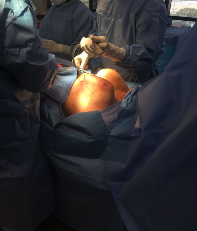 Breast implant changing