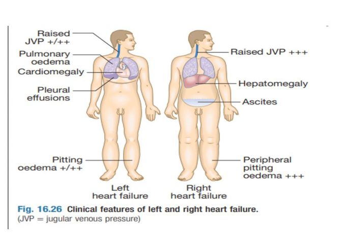 Left Heart Failure Vs Right Heart Failure