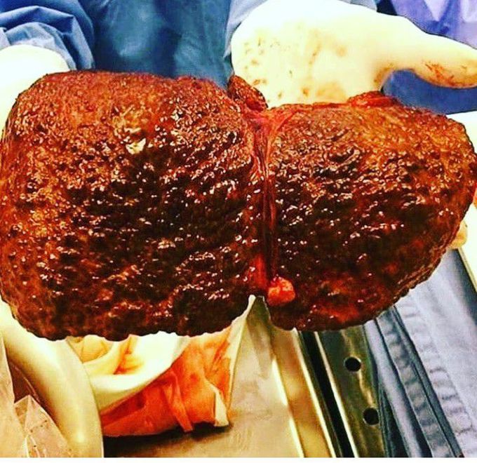 Liver Cirrhosis...