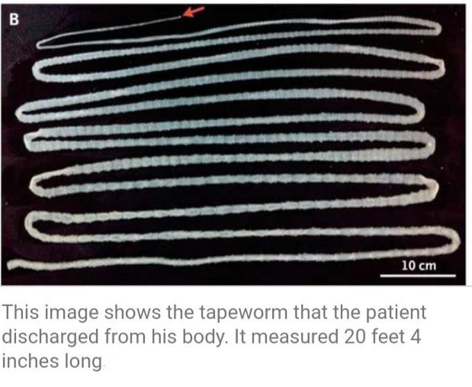 Enormous Tapeworm