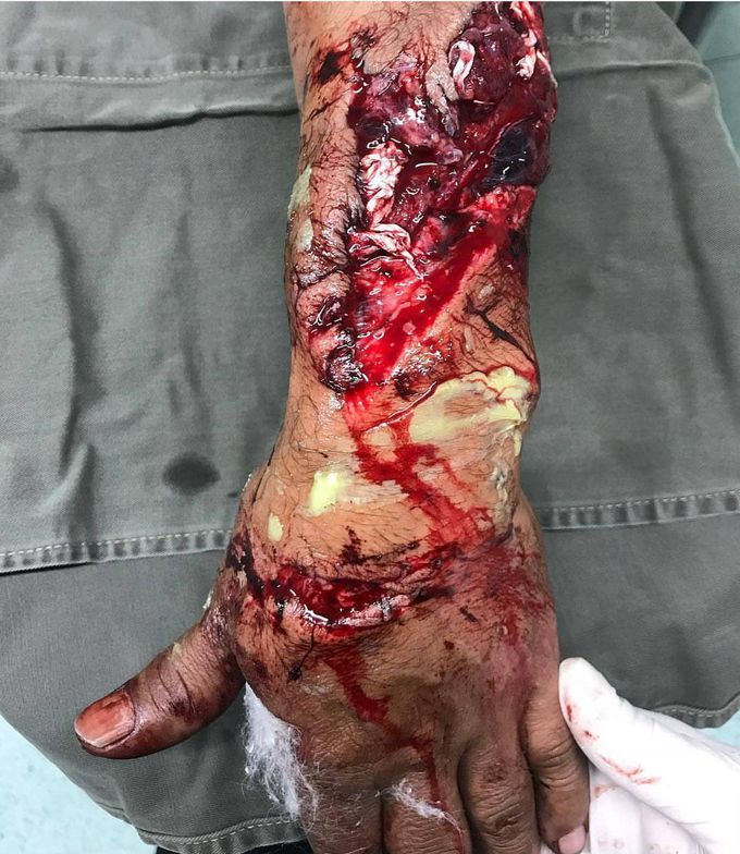 Left arm injury....
