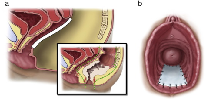 a, and 2b: Sagittal illustration of vagina demonstrating position and location of allograft mesh, and en-block resection (inset). 2b: Depiction of vagina (lithotomy view) demonstrating position and location of allograft mesh. Illustration Courtesy Beth K. Lozanoff, CMI, John A. Burns School of Medicine, Honolulu, HI.