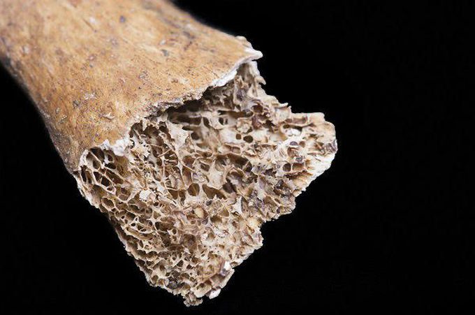 Osteoporosis