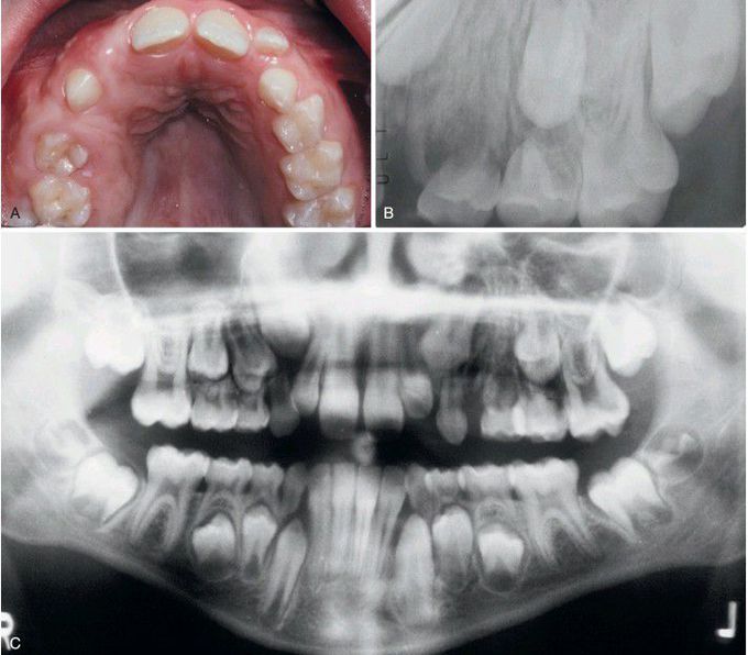 Segmental Odontomaxillary Dysplasia.