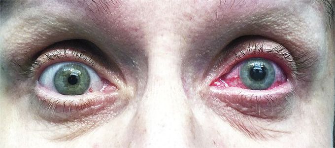 Acute Angle-Closure Glaucoma