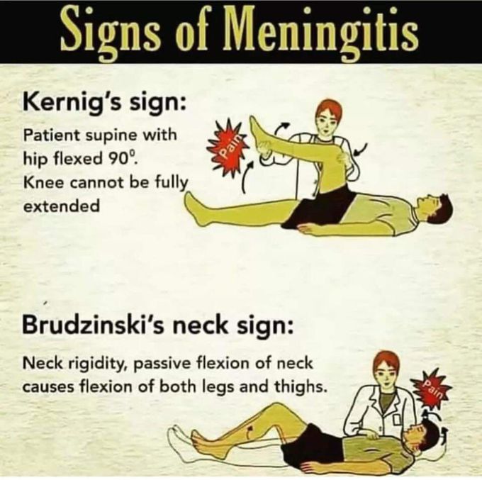 SIGNS OF MENINGITIS