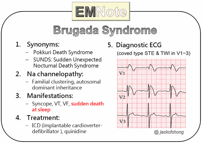 Symptoms of brugada syndrome