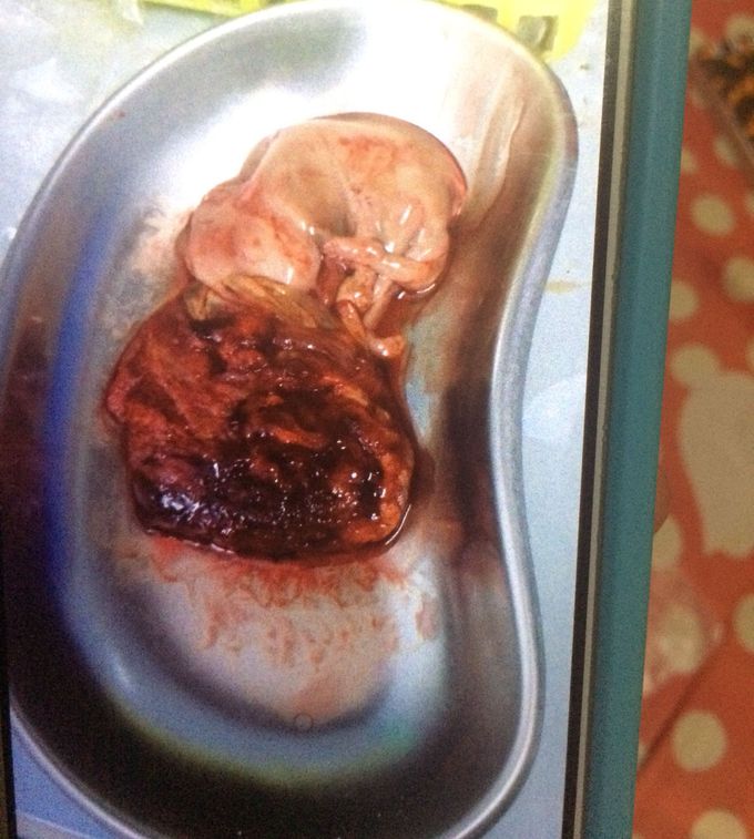 it’s called “abortus” in my country
