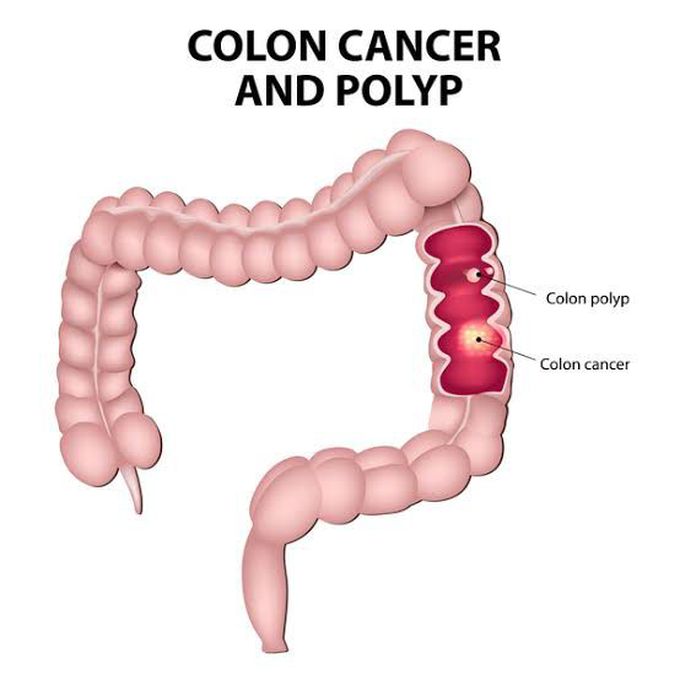 Can juvenile polyposis lead to cancer?