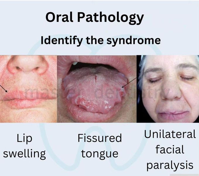 Identify the Syndrome
