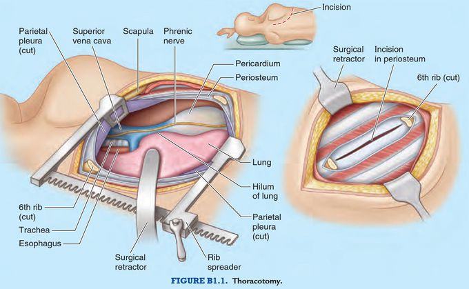 Thoracotomy, Intercostal Space Incisions, and Rib Excision