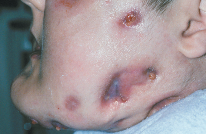 OSTEOPETROSIS