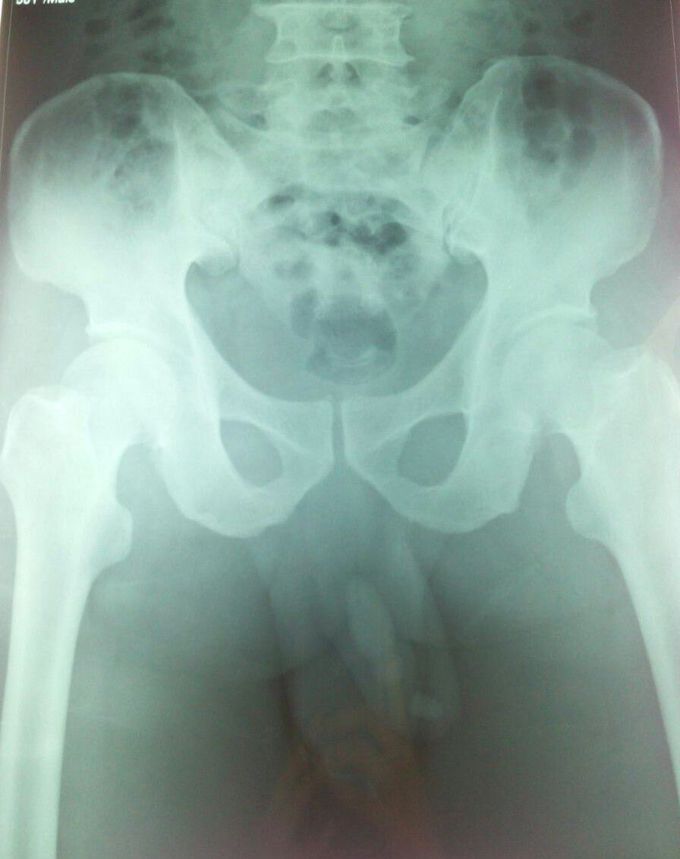 Urethrolithiasis