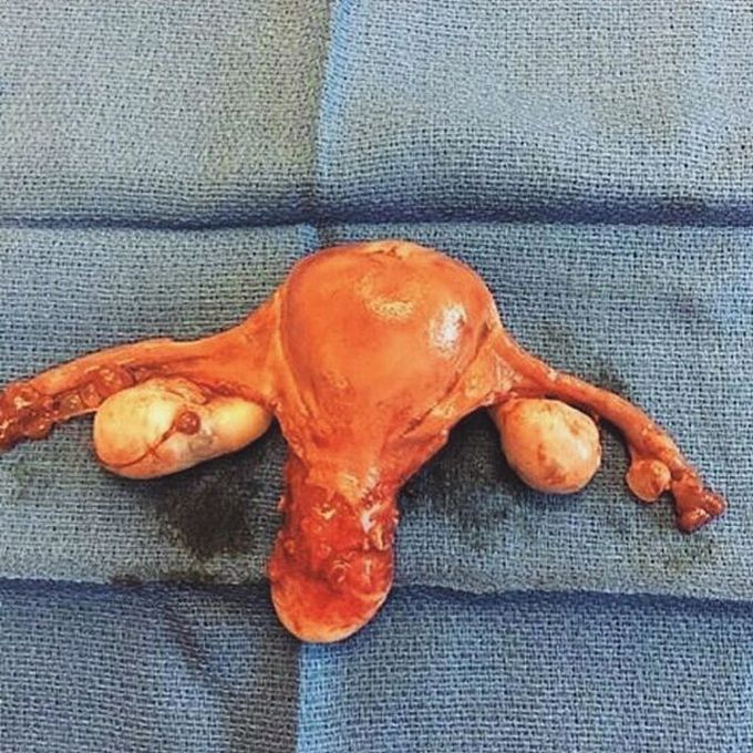 Total Hysterectomy