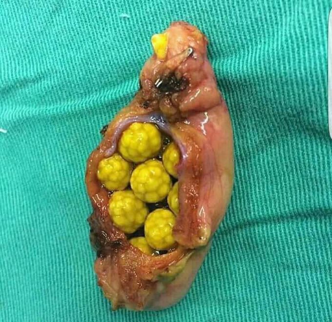 Gallstone