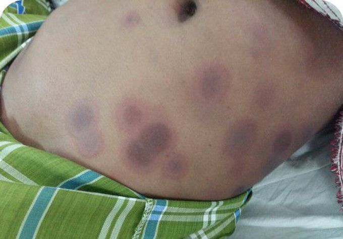 Patient presented with Generalised tonic clonic seizures &amp; treated with unknown antiepileptic drug. Came WITH this lesion ...Dx?